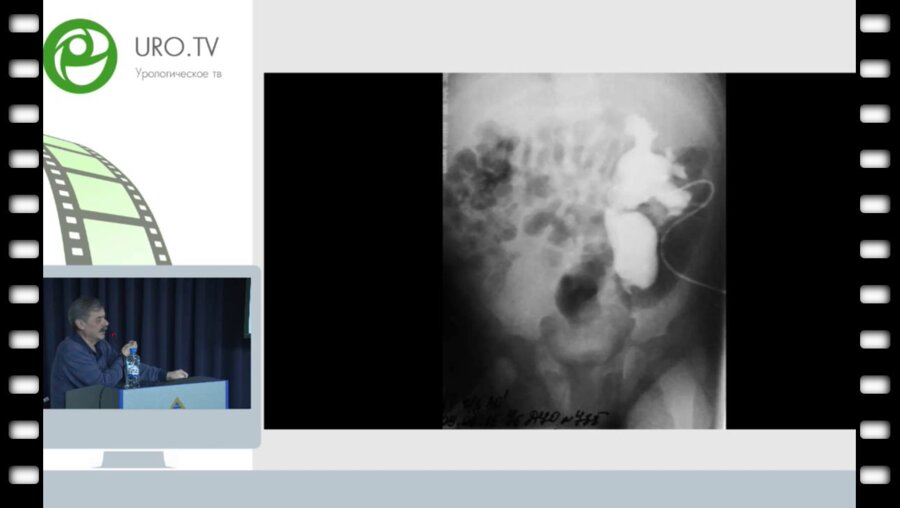 Бондаренко С.Г. - Лапароскопические операции в детской урологии в сложных случаях