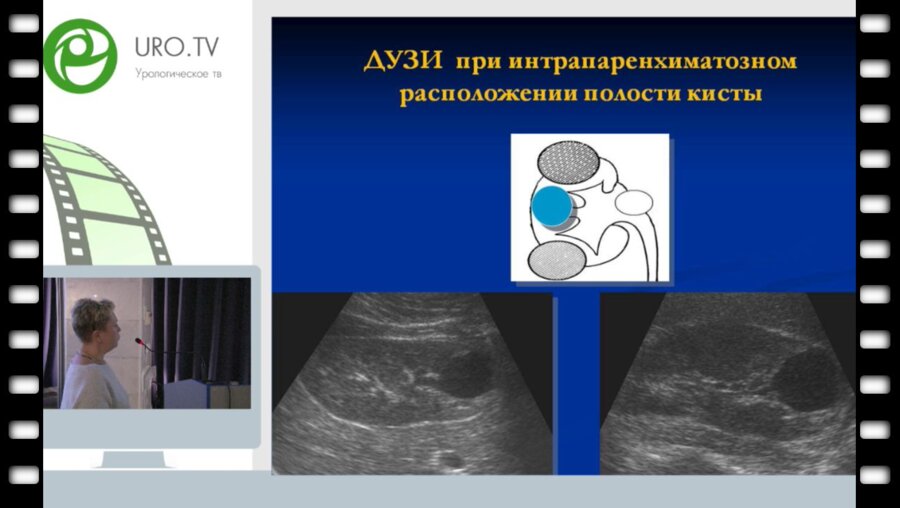 Врублевская Е.Н. - Диагностика и тактика лечения детей с кортикальными кистозными поражениями почек