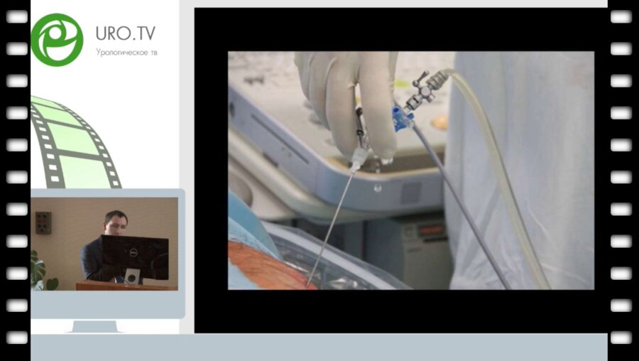 Орлов И.Н. - Операция микроперкутанная нефролитотрипсия под УЗИ контролем