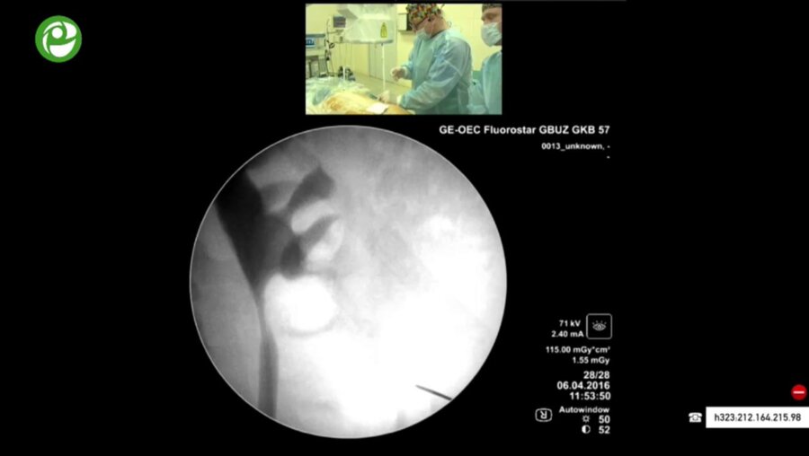 Перкутанная мининефролитотрипсия справа
