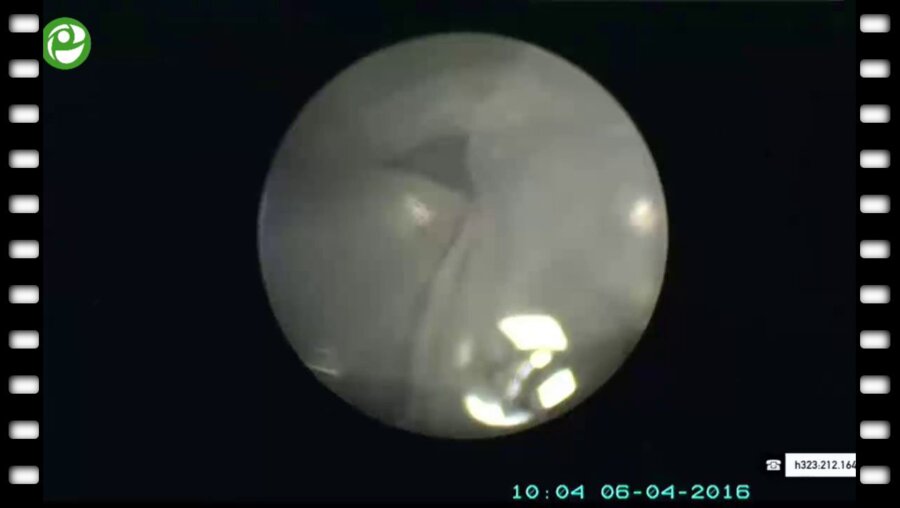 Стандартная перкутанная нефролитолапаксия справа