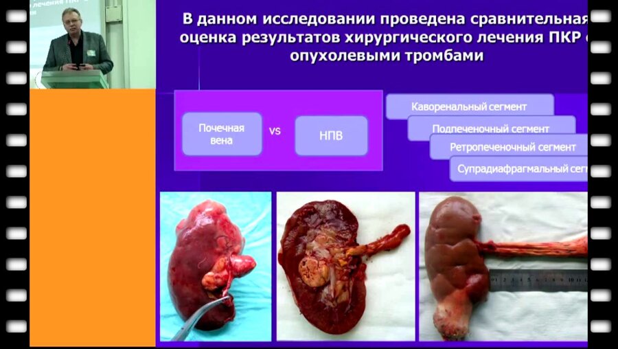 Лесовой В.Н. - Результаты хирургического лечения почечно-клеточного рака с внутривенозным распространением