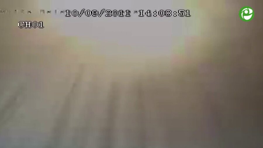 Лапароскопическая резекция почки