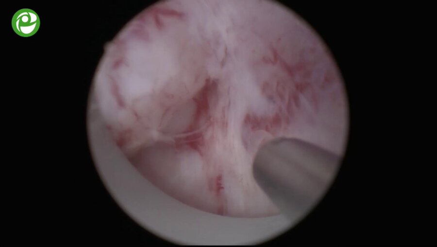 Секция живой хирургии: Тулиевая энуклеация гиперплазии простаты.