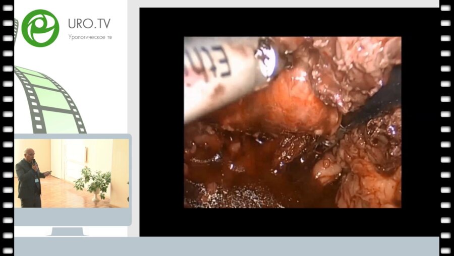 Гулиев Б.Г. - Лапароскопическая кишечно-аппендикулярная пластика мочеточников