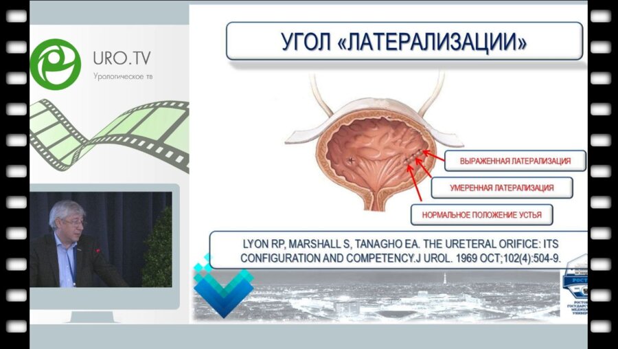 Сизонов В.В. - Латерализация устья мочеточника при везикоуретеральном рефлюксе - миф или реальность?