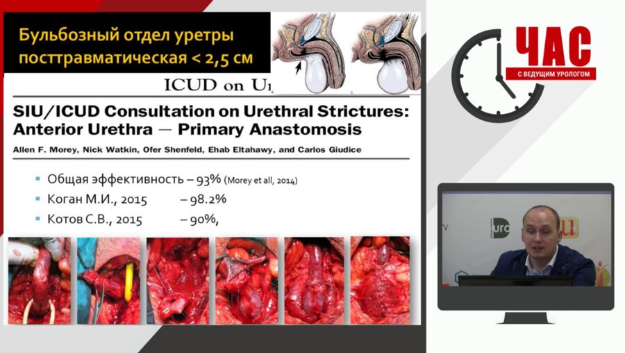 «Час с ведущим урологом». Выбор оптимального метода уретропластики при стриктурах у мужчин