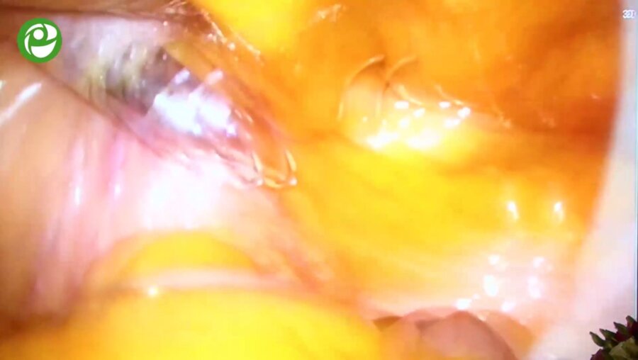 Галлямов Э.А. - Лапароскопическая парциальная нефрэктомия