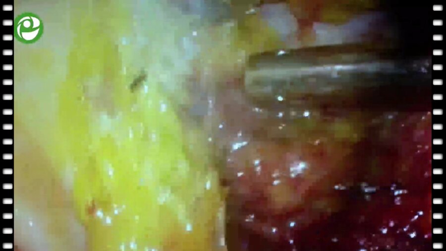 Попов С.В. – Лапароскопическая нервосохраняющая простатэктомия