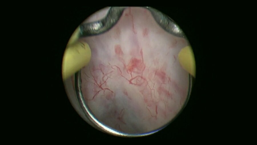 Мартов А.Г. - Биполярная трансуретральная резекция простаты