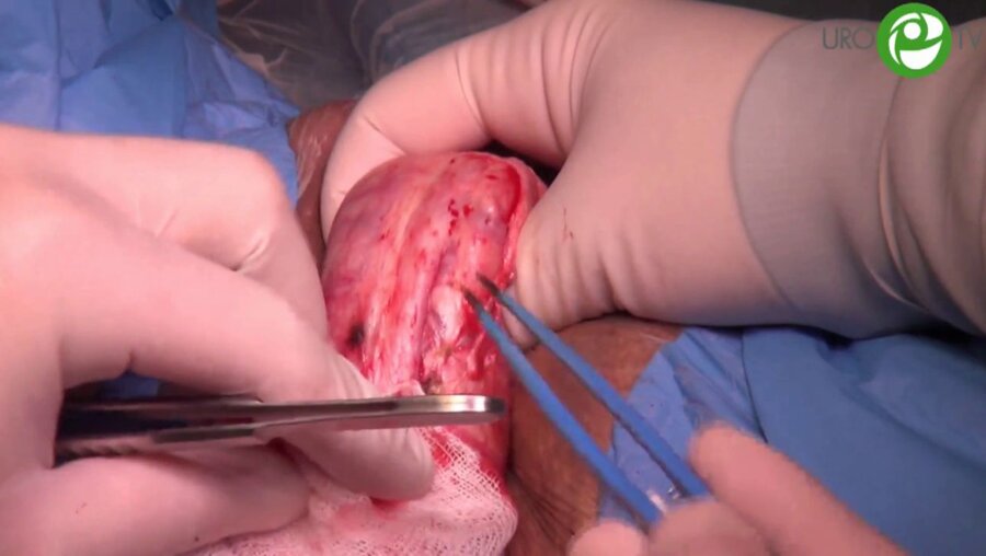 Аугментационный анастомоз с использованием буккального графта - Котов С.В.