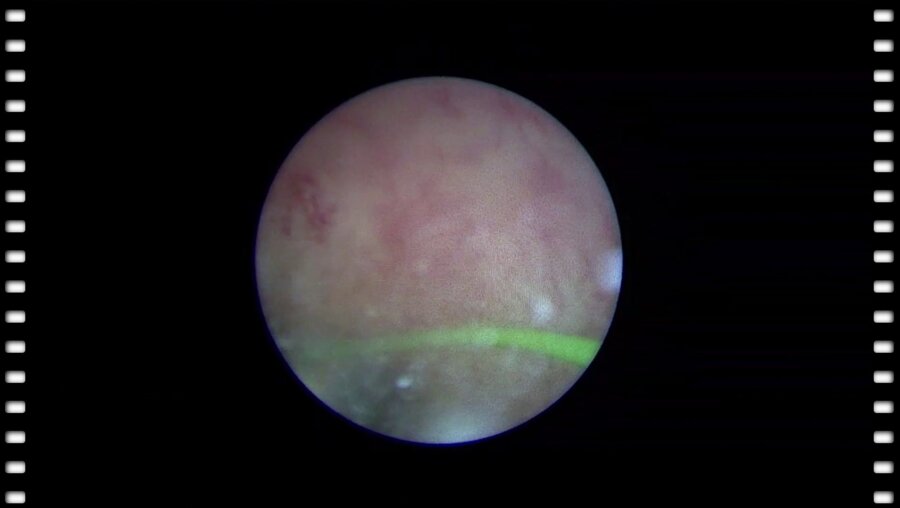 Мартов А.Г. - Тулиевая вапоризация папиллярной опухоли верхних мочевых путей