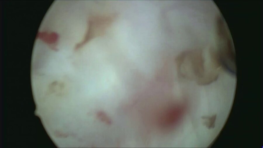 Еникеев Д.В. - Тулиевая энуклеация гиперплазии простаты российским лазером