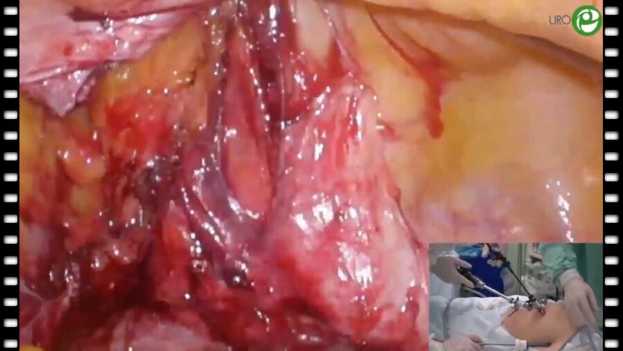 Лапароскопическая пластика мочеточника