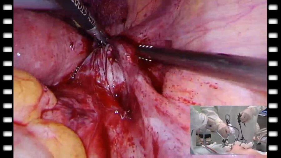 Лапароскопический уретероцистоанастомоз справа