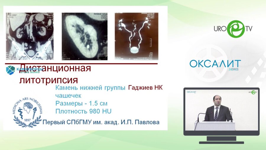 Гаджиев Н.К. - Камень в нижней руппе чашечек 1,5 см - ДПТ против РИРС