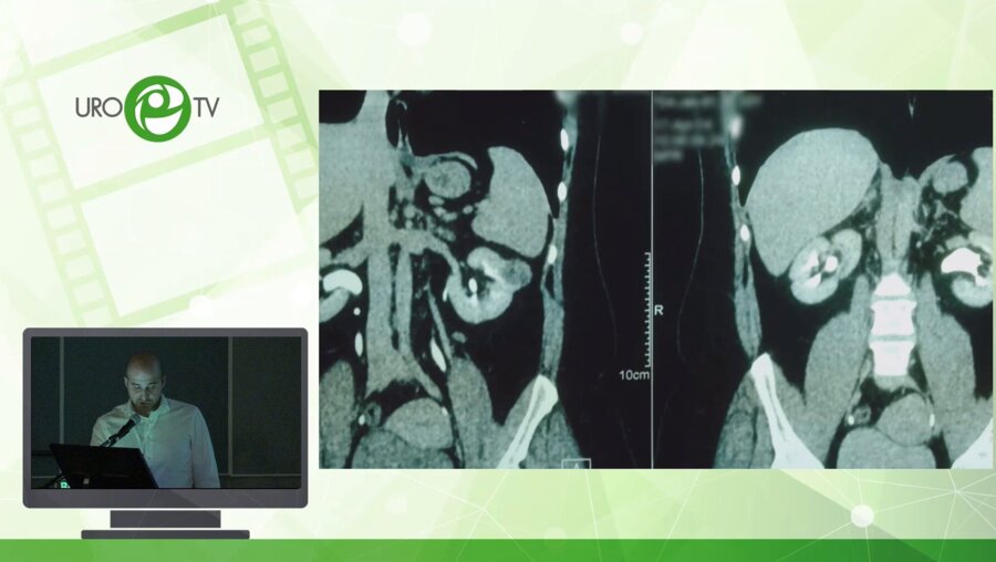 Камалов Д.М. - Лапароскопическая робот-ассистированная резекция почки