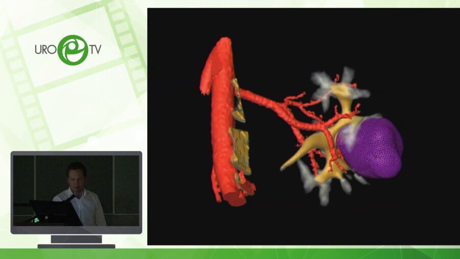 Шпоть Е.В. - Техника энуклеации опухоли почки в условиях нулевой ишемии
