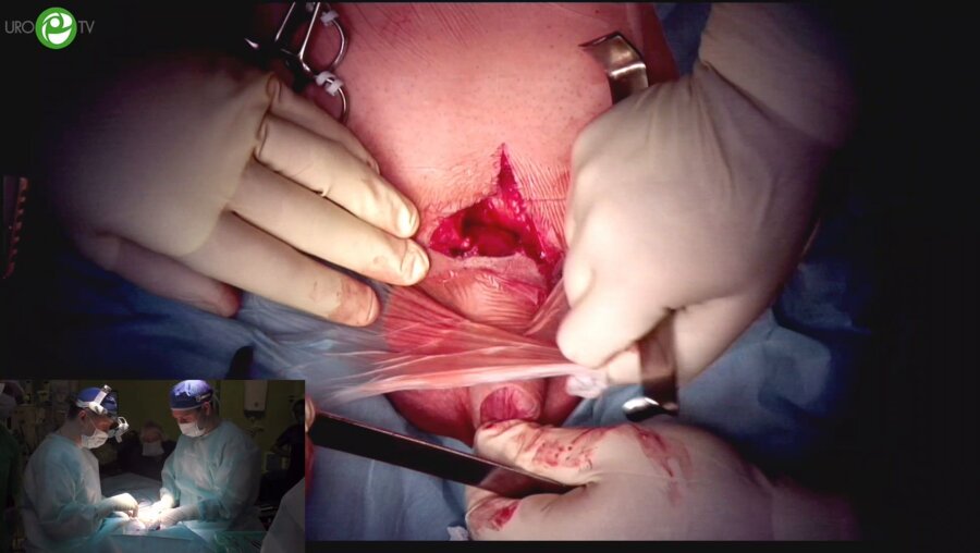 Гулько А.М. - Лигаментотомия полового члена