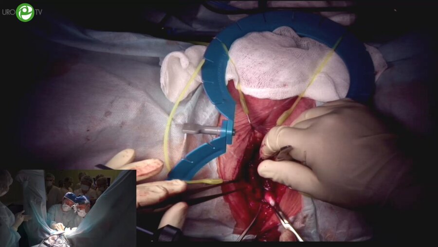 Гринь Е.А. - Анастомотическая уретропластика бульбозного отдела