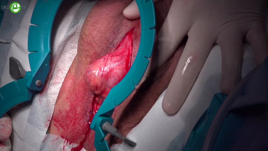 Анастомотическая пластика луковичного отдела уретры. Буккальная пластика головчатого отдела уретры