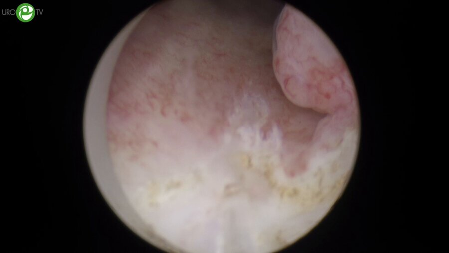 Тулиевая лазерная энуклеация гиперплазии простаты. РИРХ. Лазерная en-bloc резекция стенки мочевого пузыря с опухолью