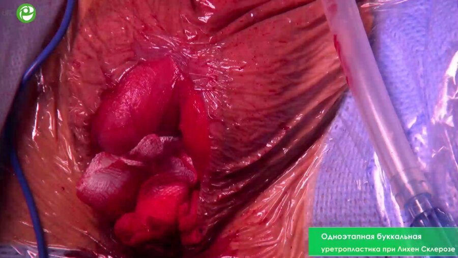 Одноэтапная буккальная уретропластика при Лихен Склерозе