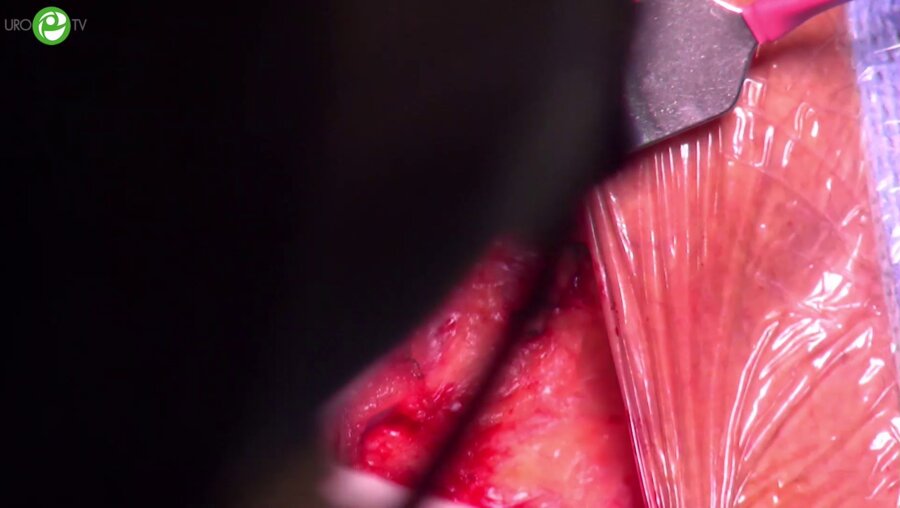 Пластика уретры буккальным графтом (Кодама)