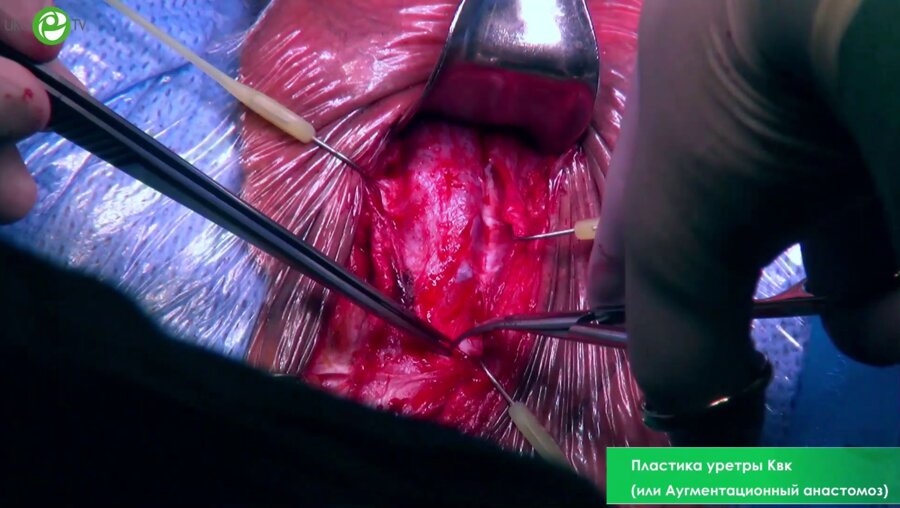 Пластика уретры Квк (или Аугментационный анастомоз)