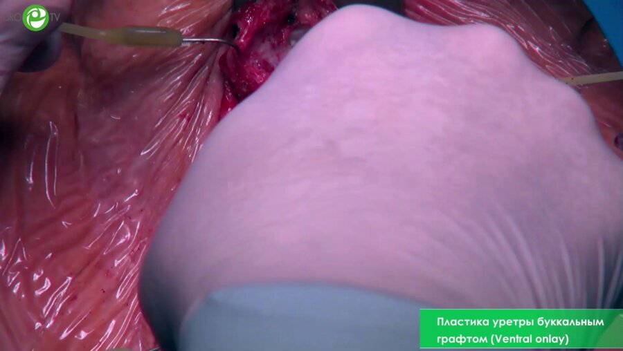 Пластика уретры буккальным графтом (Ventral onlay)