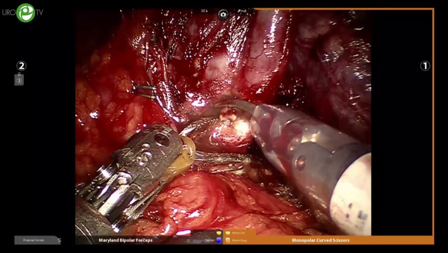 Пушкарь Д.Ю. - Робот – ассистированная нервосберегающая простатэктомия. Попов С.В. - Лапароскпическая монопортовая простатэктомия
