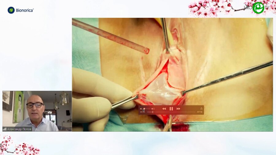 Попов А.А. - Влагалищная пластика пролапса синтетическим имплантом OPUR