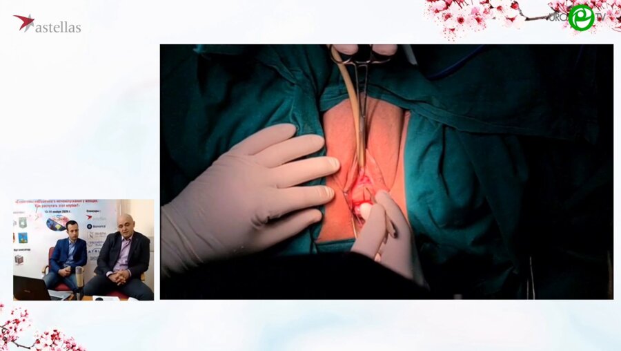 Шкодкин С.В. - Манчестерская операция, субуретральный слинг