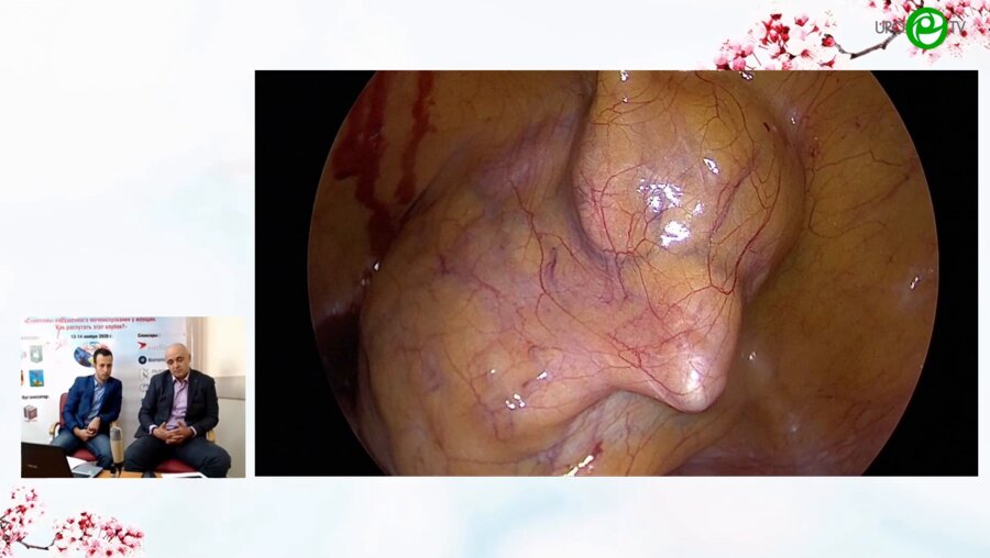 Шкодкин С.В. - Лапароскопическая кольпосуспензия по Burch