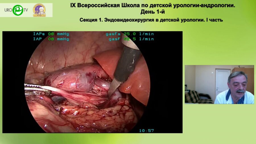 Бондаренко С.Г. - Лапароскопическая пиелопластика ротационным лоскутом. Показания и техника операции