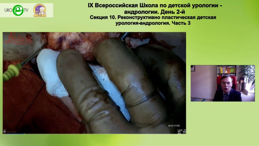 Батрутдинов Р.Т. - Операция Kelly (radical soft tissue mobilization) при повторной операции у девочки с экстрофией мочевого пузыря