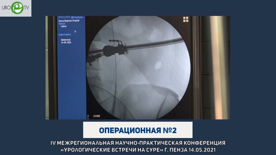 Дымов А.М. - МикроПНЛТ (всевидящая игла)