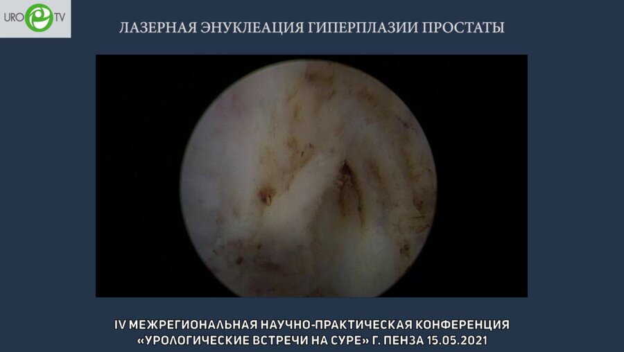 Дымов А.М. - Лазерная Энуклеация гиперплазии простаты