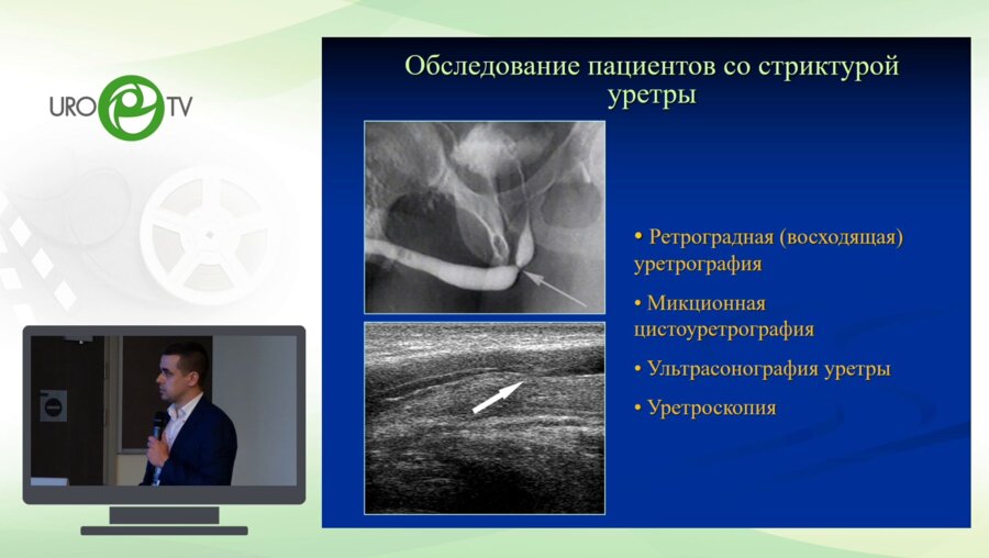 Байков Н.А. - Отдаленные результаты эндоскопического лечения стриктур уретры у мужчин