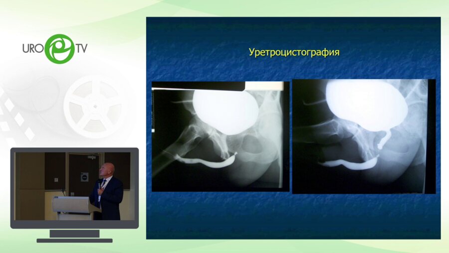 Даренков С.П. - Дистракционный дефект уретры при переломах костей таза