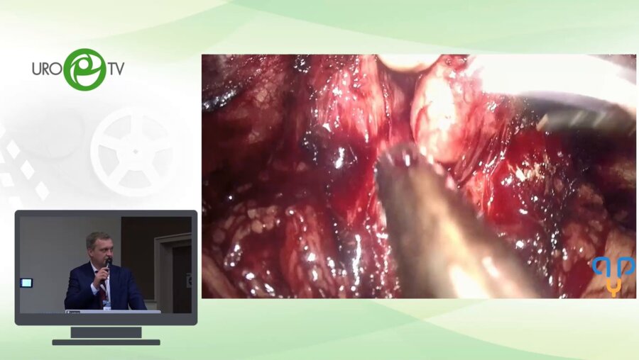 Новиков А.Б - Лапароскопичеякая радикальная простатэктомия варианты реконструктивного этапа