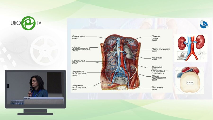 Берлизева О.Ю. - Ультразвуковая диагностика при варикозном расширении вен малого таза и СХТБ у мужчин