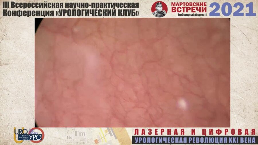 Волков С.Н. -Операция Лазерная en bloc резекция опухоли мочевого пузыря