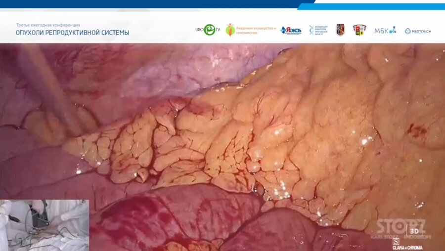 Котов С.В. - Трансляция из операционной ГБУЗ ЯО Областная клиническая онкологическая больница. Радикальная лапароскопическая простатэктомия
