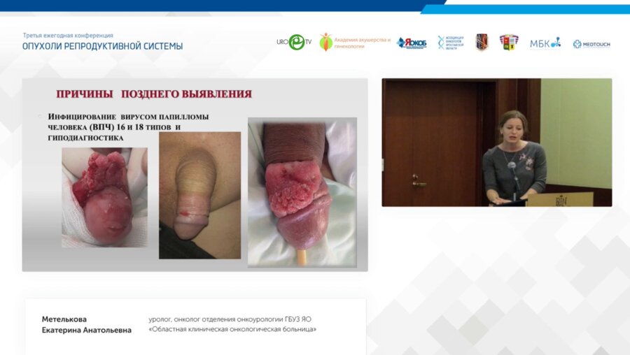 Метелькова Е.А. - Рак полового члена