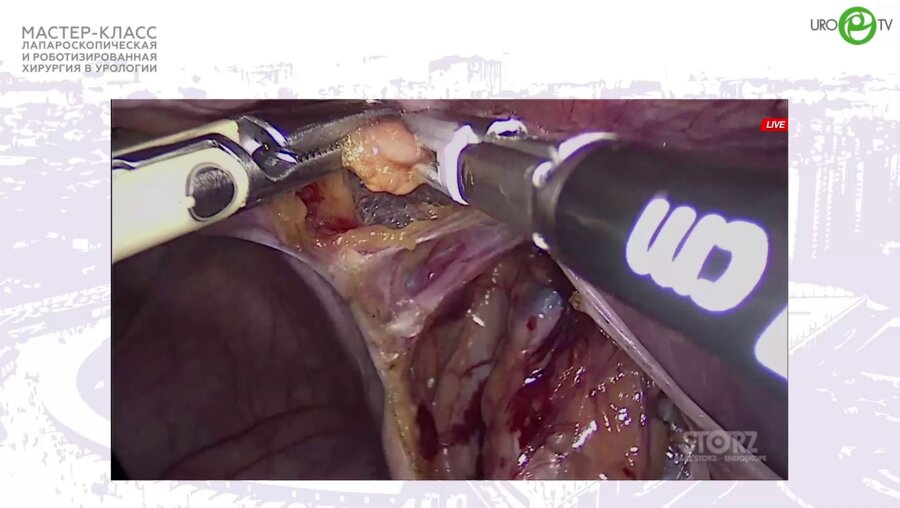 Димитриади С.Н. - Лапароскопическая радикальная простатэктомия с лимфодиссекцией