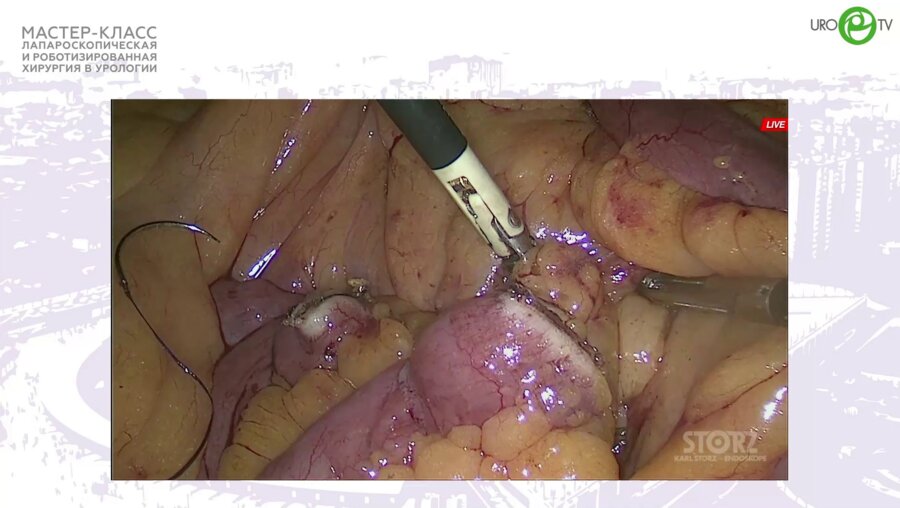 Кочкин А.Д. - Лапароскопическая кишечная пластика мочеточника