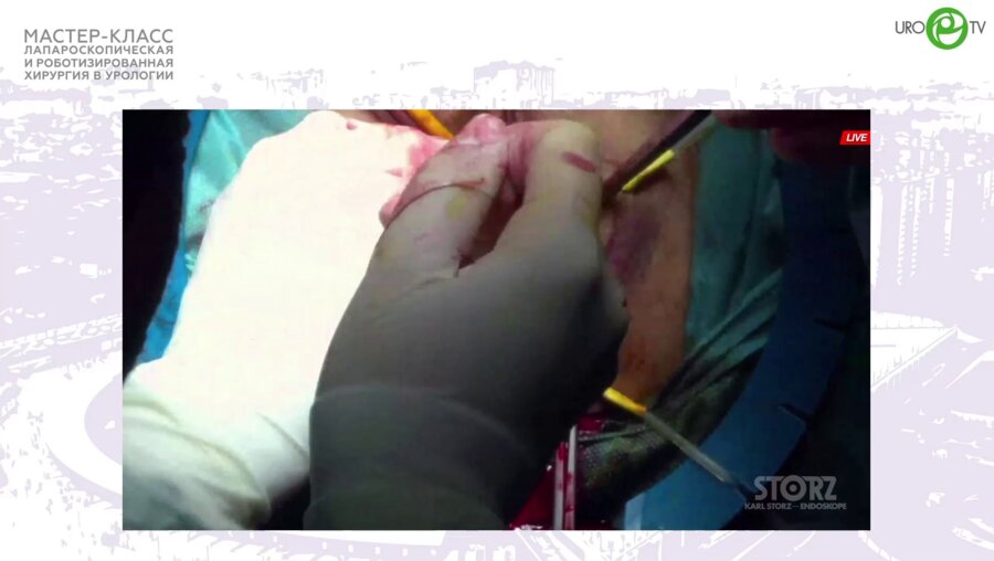 Пучков К.В. - Лапароскопическая кольпосакровагинопексия