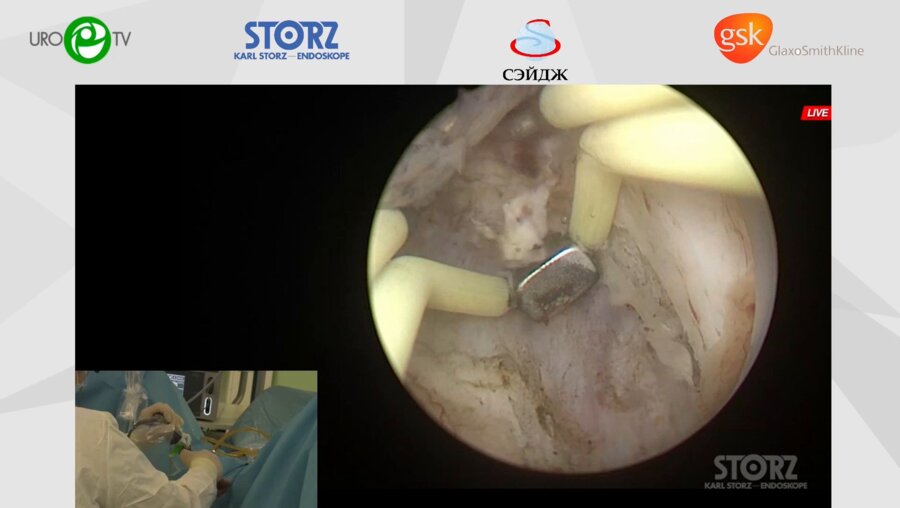 Мартов А.Г. - Биполярная энуклеация простаты