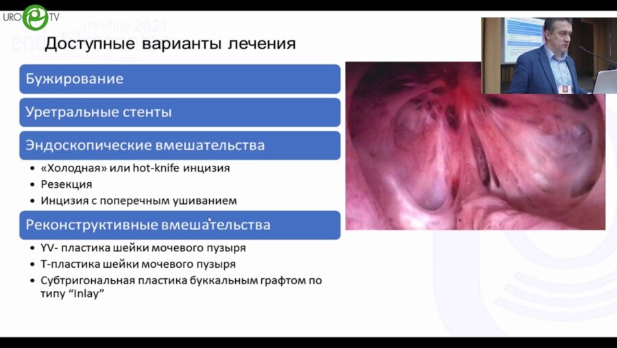 Орлов И.Н. - YV-пластика шейки мочевого пузыря при рецидивирующем стенозе
